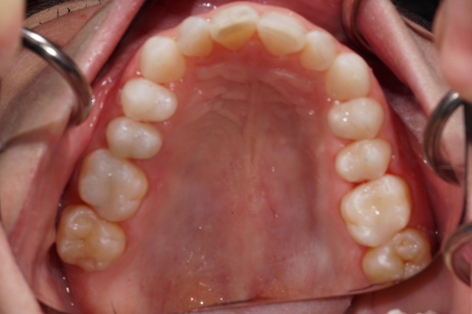 Noninvasive reconstruction of occlusion with bonded composites
