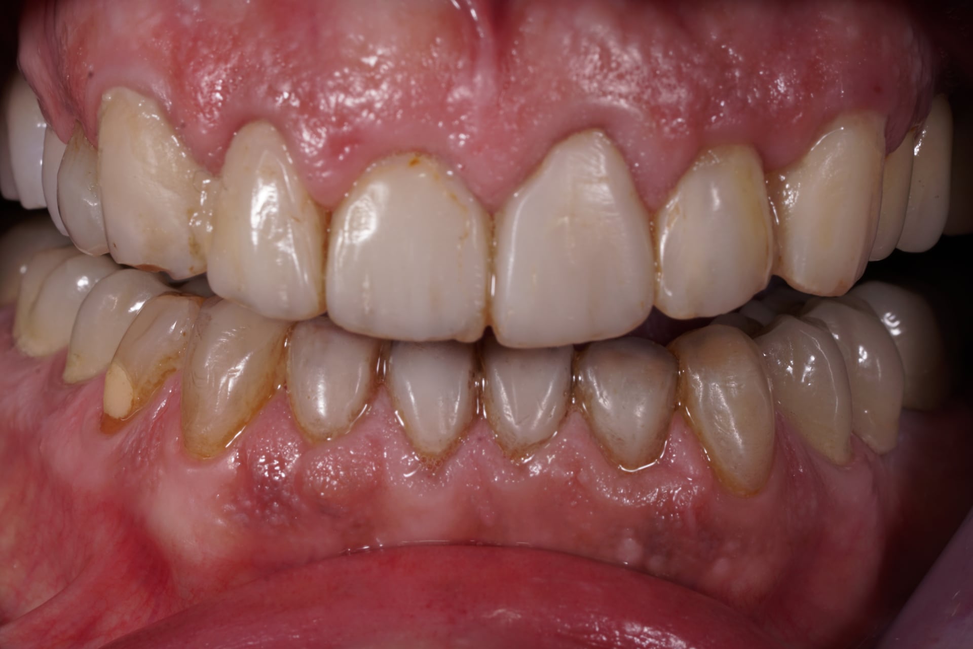 Composite veneers to lengthen front teeth Dental Aesthetics