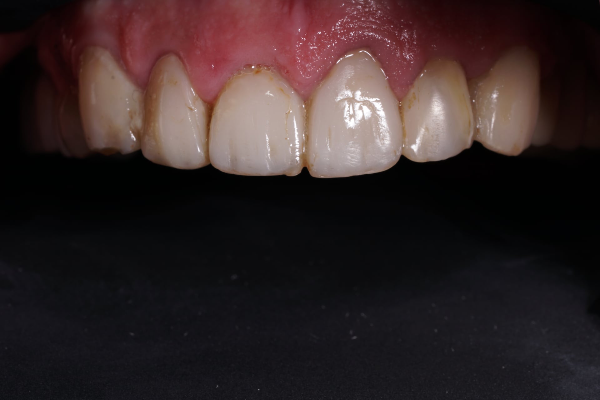 Composite veneers to lengthen front teeth Dental Aesthetics