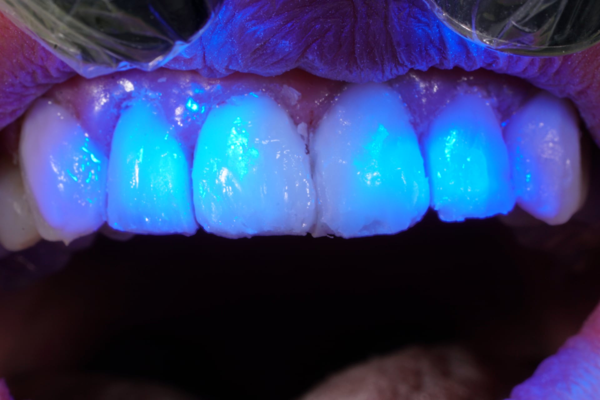 Composite veneers to lengthen front teeth Dental Aesthetics