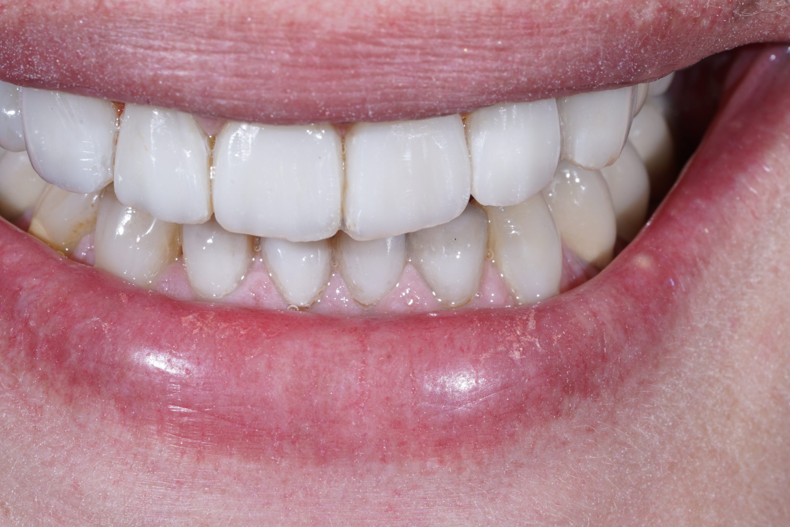 Composite veneers to lengthen front teeth Dental Aesthetics