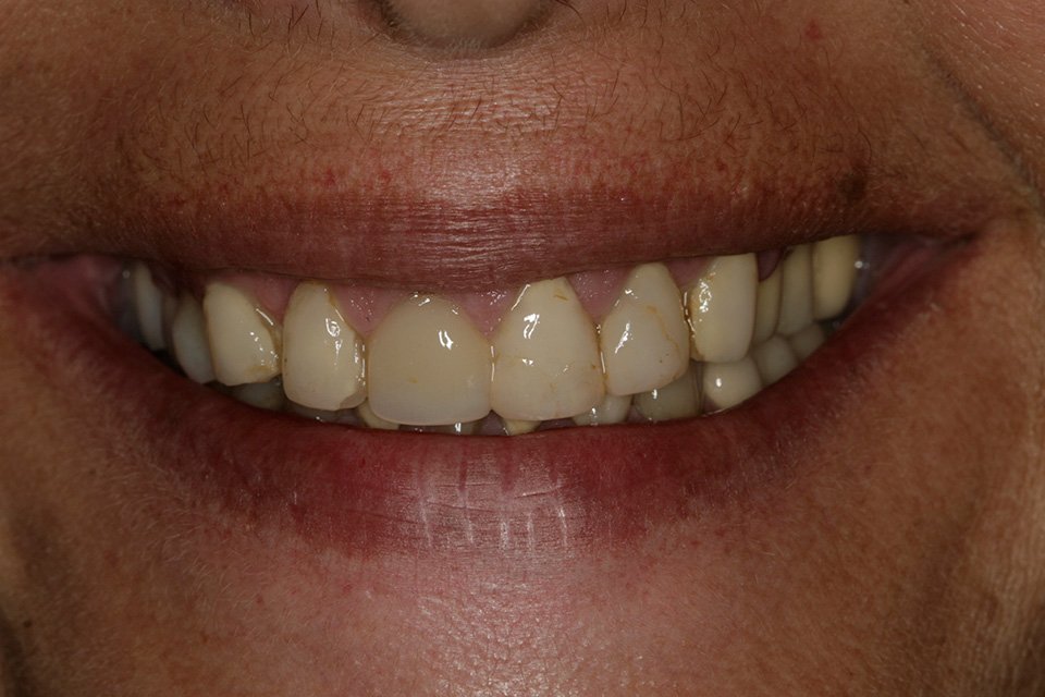 Composite veneers to lengthen front teeth Dental Aesthetics